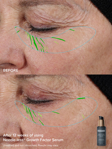 The Needle-less® Duo